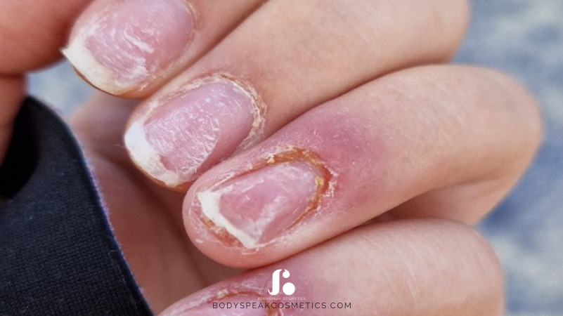 Acrylaten allergieën en kunstnagelproducten