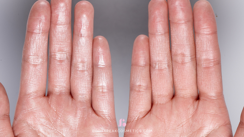 Hyperhidrose aan de Handen: Een Gids voor Nagelstylisten